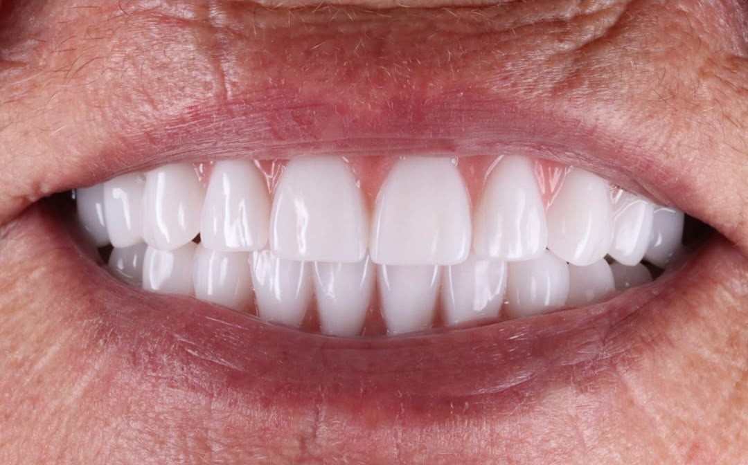 Detalhe de um sorriso com os dentes à mostra