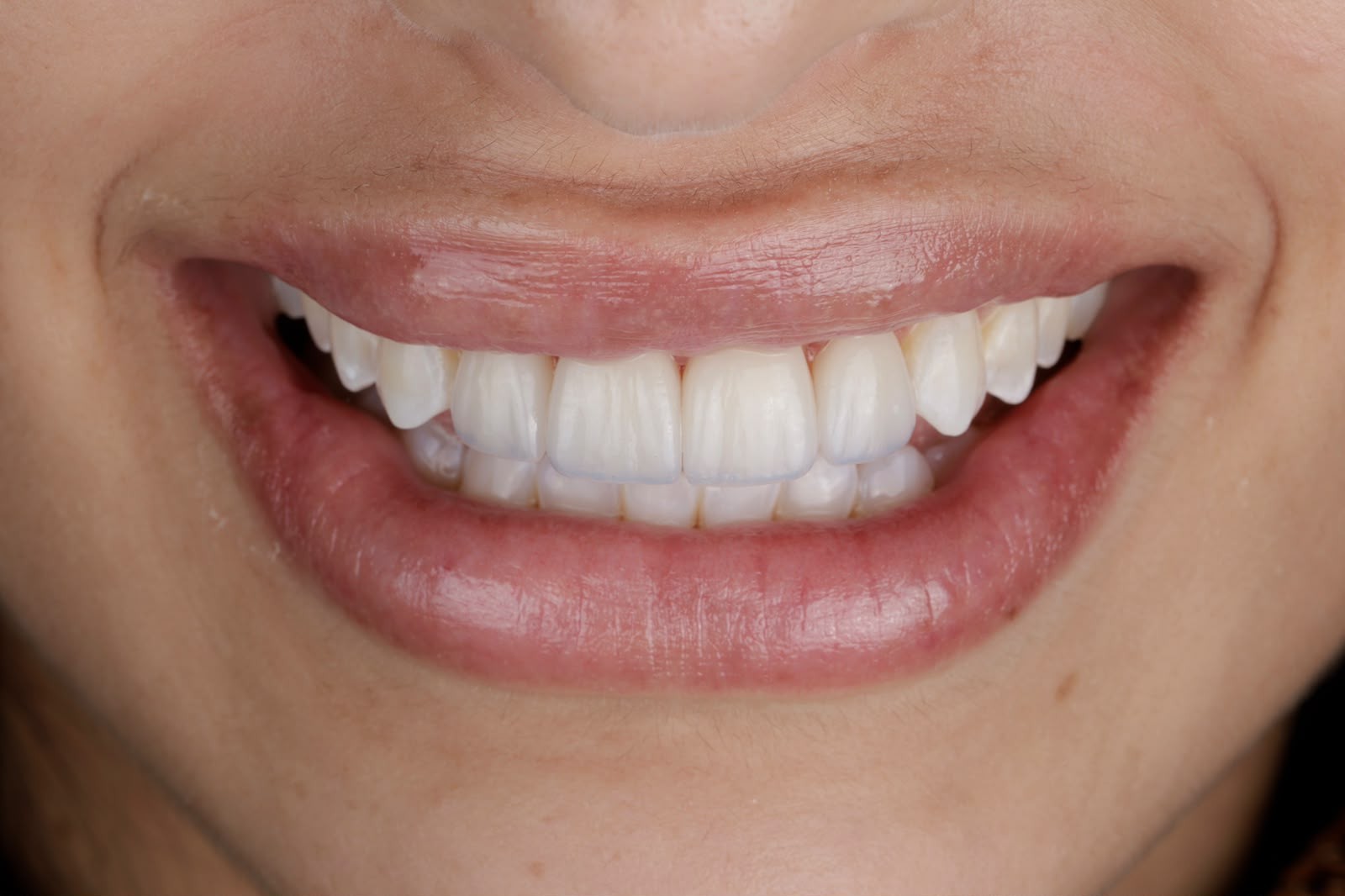 Detalhe de um sorriso com dentes claros e alinhados